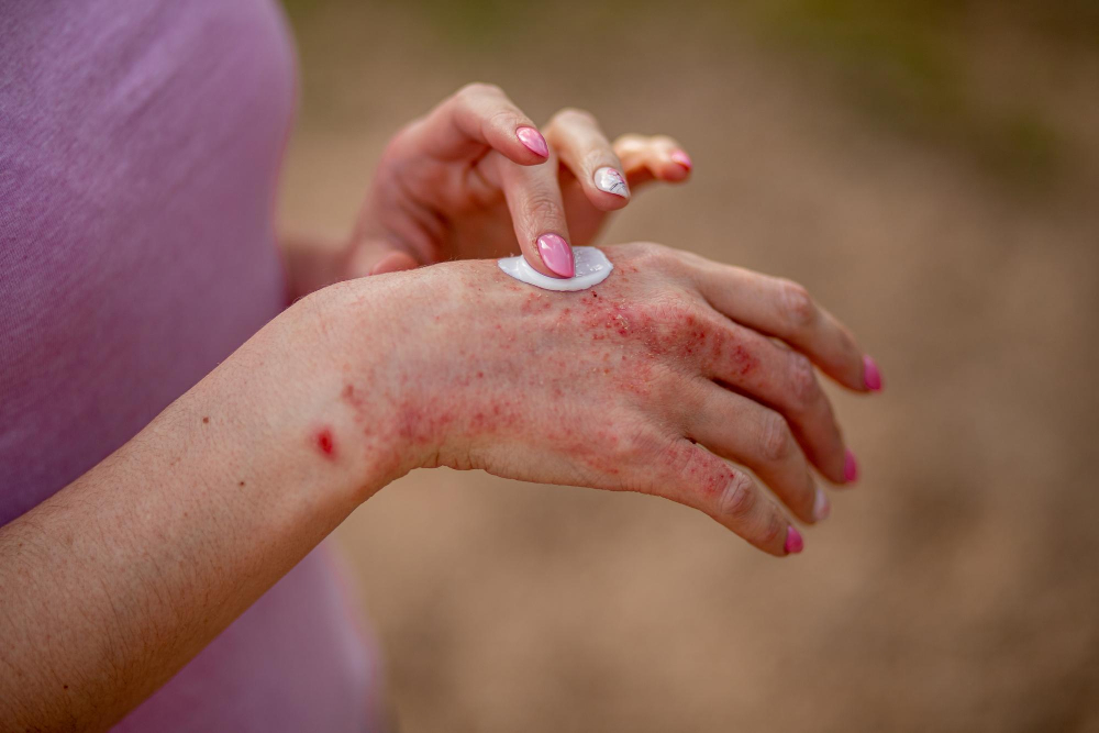 Rashes and Burns Treatment in Houston, TX